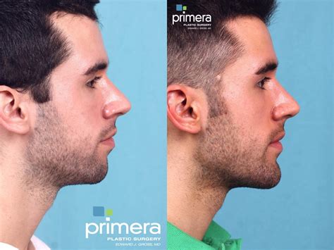 Cheekbone Implants Men Before And After