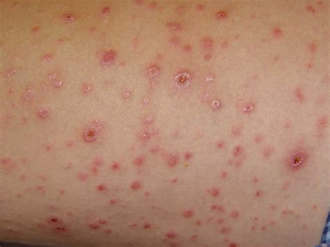 Pityriasis Lichenoides