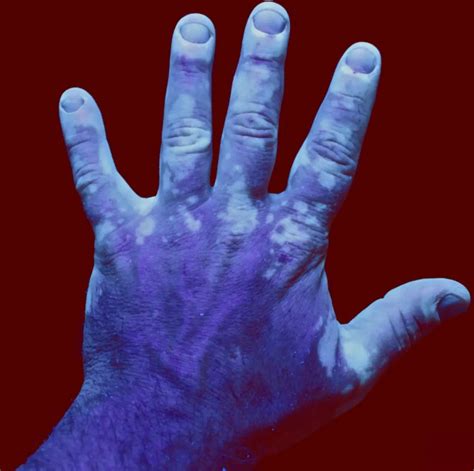 Ný gen tengd vitiligo hafa fundist - Heilbrigður matur nálægt mér