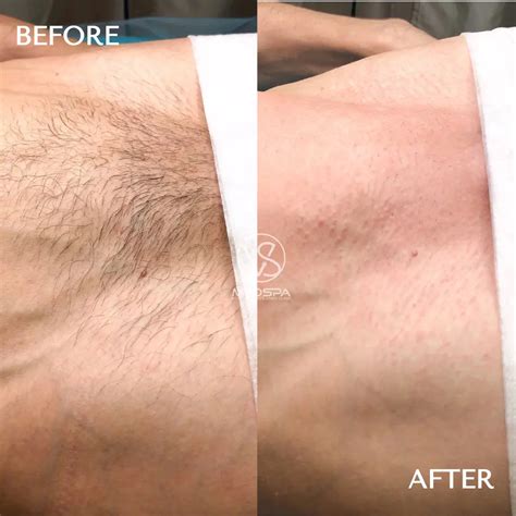 Brazilian Laser Hair Removal Before And After Photos