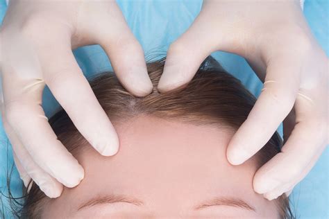 Understanding Mohs Surgery on the Scalp: Before, After, and What to Expect | Dermatology and ...
