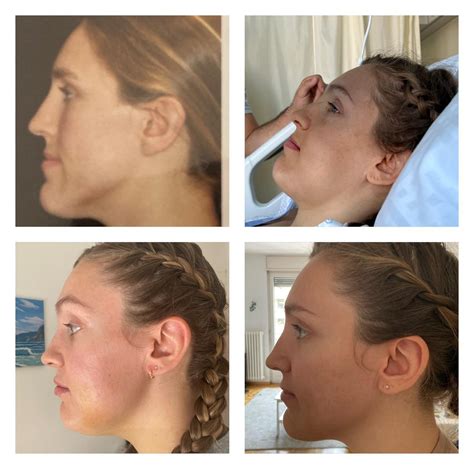 Double jaw surgery procedure yesterday : r/jawsurgery