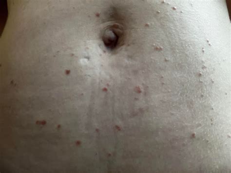 I would love some help. Rash that spread from torso onto back and arms over a period of two ...
