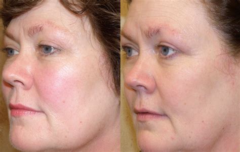Laser For Rosacea at Craig Alston blog
