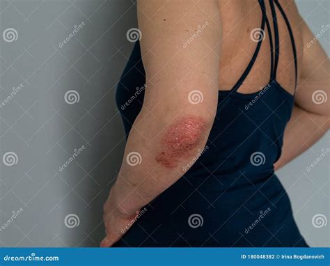How To Treat Itchy Rash On Elbow at Georgia Challis blog