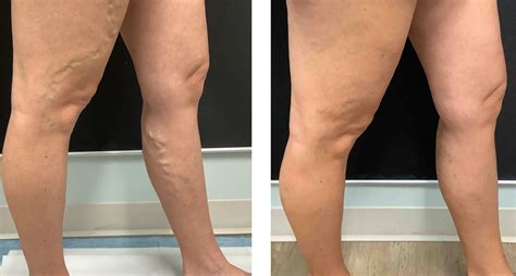 Will Exercise Help Venous Insufficiency at Timothy Samons blog