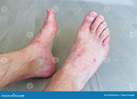 Close Up on Many Mosquito Bites on Men& X27;s Foot Skin. Stock Photo - Image of mosquitoes ...