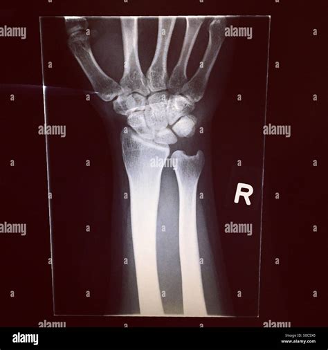 Broken wrist hi-res stock photography and images - Alamy
