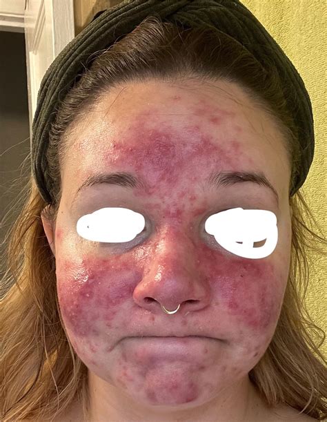 Acne turned black? Is this just blood filled or something more? Taking ...