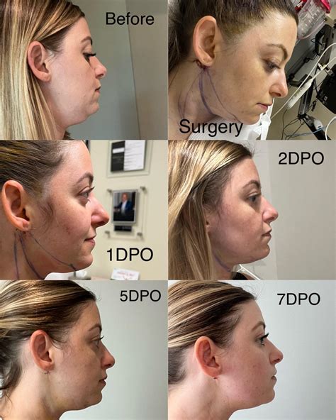 3 Months After Lipo Still Swollen