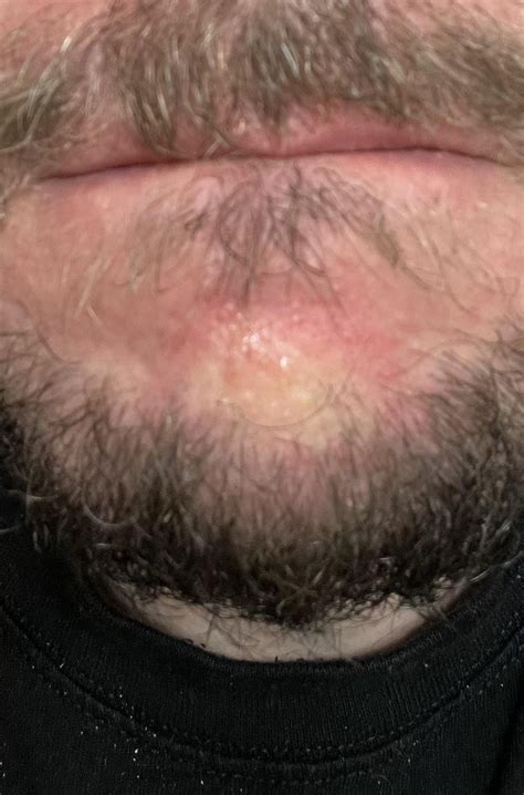Rash On Chin