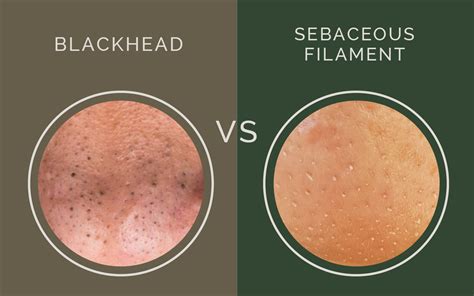 Are they blackheads or Something Else like Sebaceous Filaments? - Grounded Sage