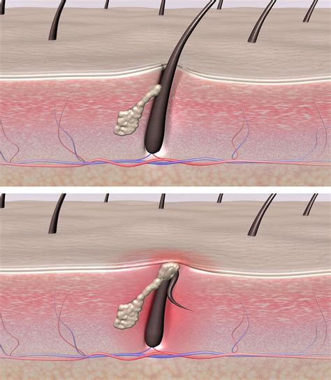 Does Waxing Cause Ingrown Hairs