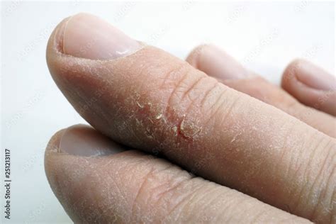 Dry cracked skin on fingers. Arms with dermatology problems. Stock ...