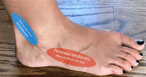 Peroneal Tendonitis Outer Side Foot Pain Chart - Educational Chart ...