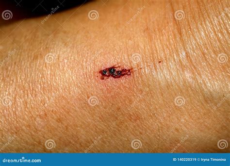 What Is Abrasion Scratch at Hannah Cadell blog