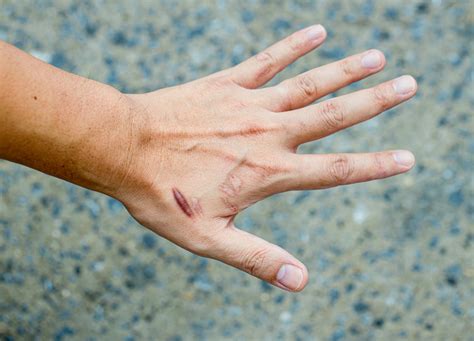 Keloid Scar Treatment In Patanjali at Susan Tucker blog