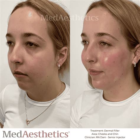 Dermal Fillers Perth | Cheek Fillers - Medaesthetics