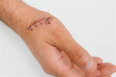 What to Expect When Getting Your Stitches Removed | The Medical Hub