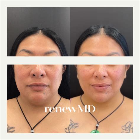 How Long Does Sculptra Take To Work? | RenewMD