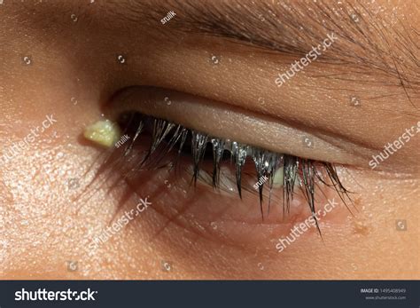 203 Crusty Eyes Images, Stock Photos & Vectors | Shutterstock