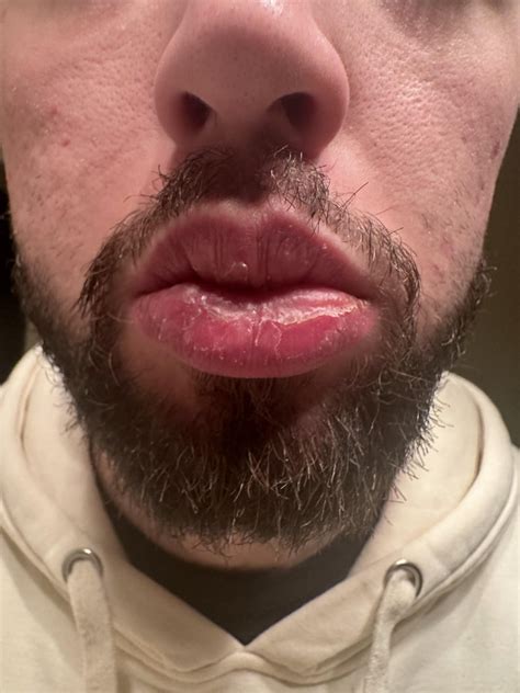 I honestly dont even know what to do about this anymore. Have had this issue for 4 years. Ive ...