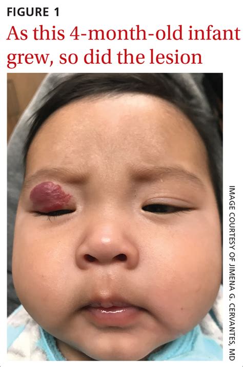 Infant with red eyelid lesion | MDedge
