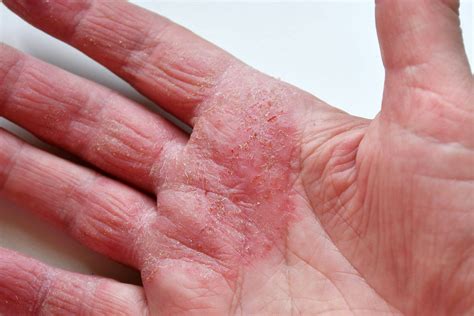Skin Allergy Dermatologist Near Me in Bensalem & Warminster, PA