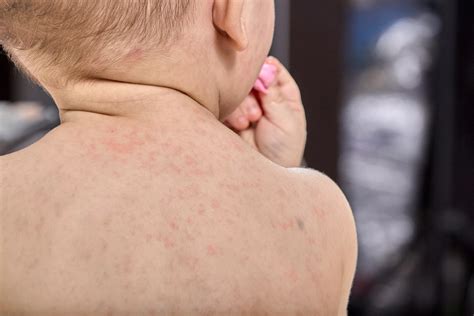 Is Roseola Contagious? Understanding this Childhood Infection