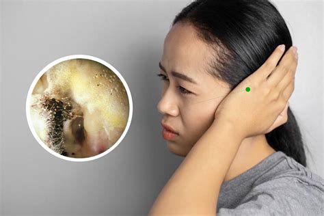 Understanding Fungal Ear Infections – Pusat Alat Bantu Dengar SOUNDLIFE ...