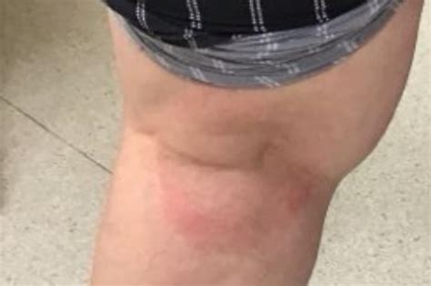 DermDx: Round Rash Behind Knee - Clinical Advisor