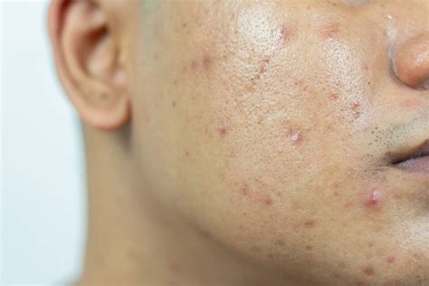 4 Key Metrics To Predict If You Will Purge With Accutane? - https ...