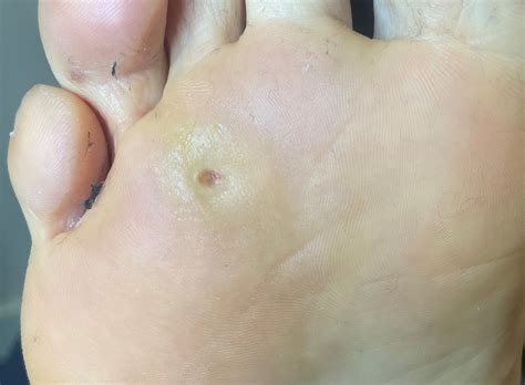 Foot Corn Enucleation at Janie Davis blog