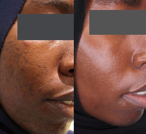 Treatment For Post Inflammatory Hyperpigmentation - Cutis Clinic