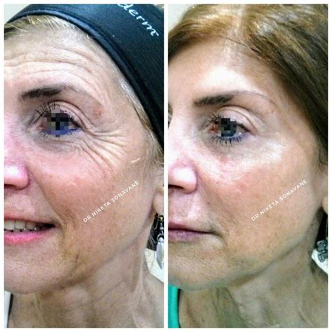 Skin Tightening Treatment in Mumbai - Cost, Before After, Procedures