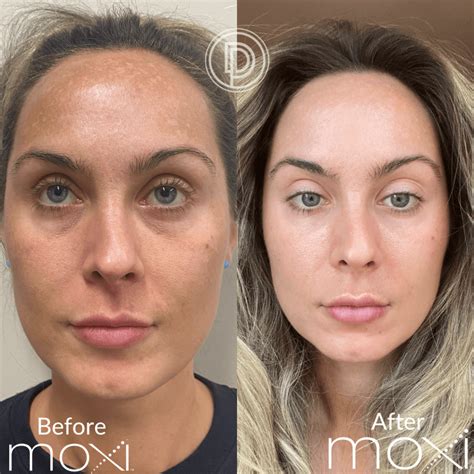 Facial Laser Treatment Before And After at Eugene Bergeron blog