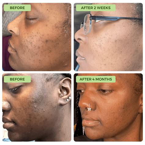 Anti-Acne & Dark Spots African Soap – Earthly Derm