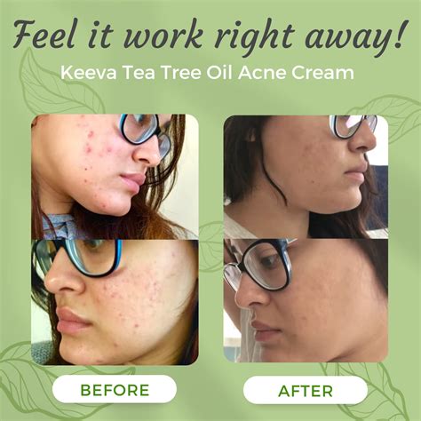 Tea Tree Oil Acne Before And After