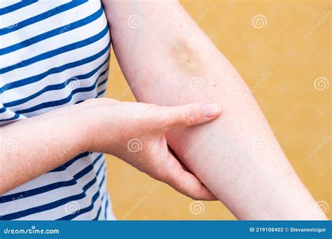 Vein Hematoma on Female Hand after Phlebotomy Stock Photo - Image of caucasian, bruise: 219108402