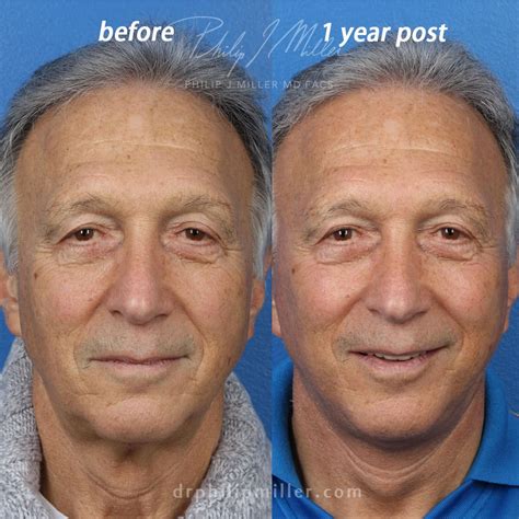 Plastic Surgery Before And After Men