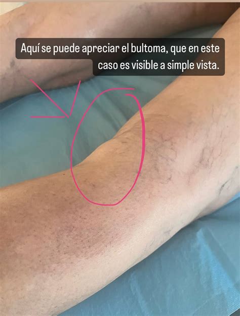 Quiste Baker Extraccion De Quiste De Baker, Fisiojreig.com YouTube