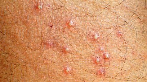 Why Do I Get Bumps After Shaving My Pubic Hair at Joel Kelley blog