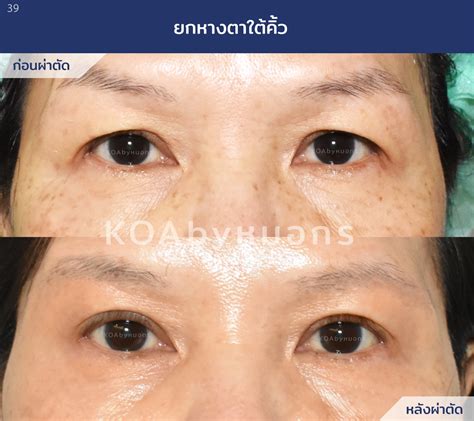 Everything You Want to Know about Droopy Eyelids and Treatment