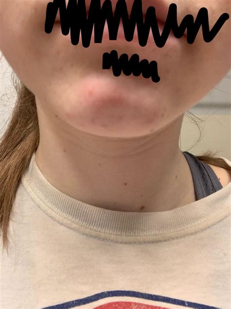 Hard Spot on Chin : r/acne