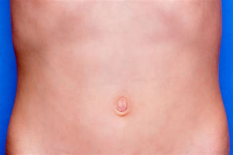 Umbilical Hernia In Women