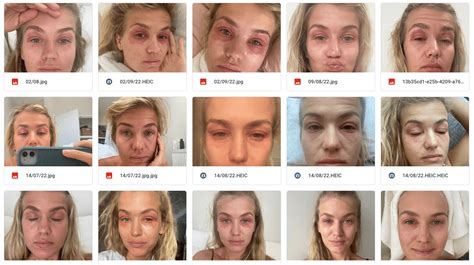 Eczema Healing Stages Pictures at Lori Novak blog