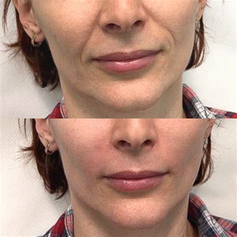 Nasolabial Folds Treatment - Rejuvenate Clinics