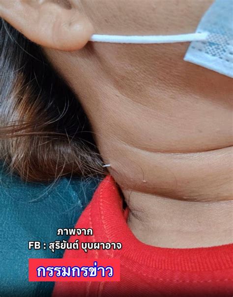 Fish bone pierces Thai woman's neck after getting swallowed, safely ...