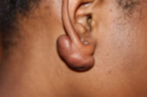 Keloid Shrinking Injections - Dr.Derme Skin Clinics