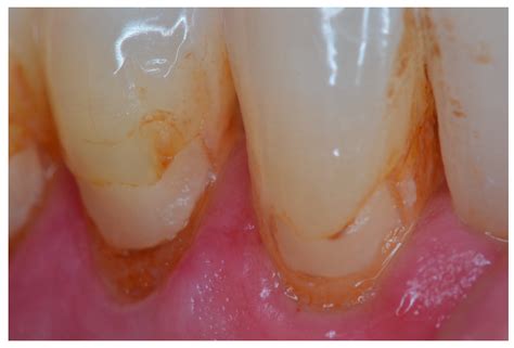 Retrospective Clinical Evaluation of RMGIC/GIC Class V Restorations